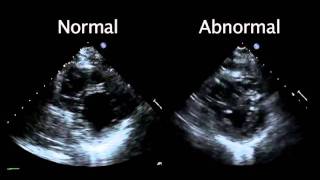 Echocardiogram from the Patient Compared with That from a Normal Control  NEJM [upl. by Nylyram]