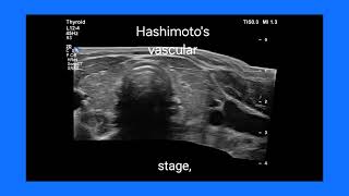 Stages of Hashimotos Thyroiditis Key Ultrasound amp color Doppler Findings Across Stages [upl. by Sualk133]