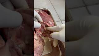 Autopsy removal of left lower lobe of lung and a large abscess cavity [upl. by Rebm]