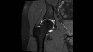 Normal MR arthrography of the hip  complete MRI examination [upl. by Kreager179]