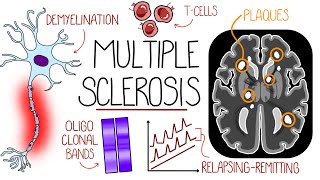 Understanding Multiple Sclerosis Multiple Sclerosis Explained [upl. by Aiekan369]