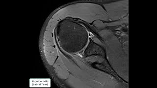 Shoulder MRI Labral Tear [upl. by Bowne817]