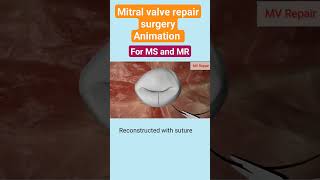 Mitral valve Repair Animation l valve Echo shorts [upl. by Rosdniw846]