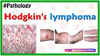 Hodgkins lymphoma Lymphogranulomatosis  Usmle Imaged based discussion [upl. by Dnalram671]