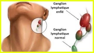 L’inflammation des ganglions lymphatiques  quelle en est la cause [upl. by Nauq]