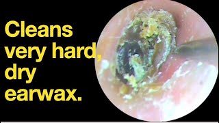 Cleans very hard dry earwax ear wax removal  ear cleaning  ASMR  relaxation  relax [upl. by Ymaj]