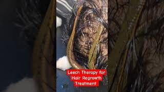 leechtherapy leeching haircare hairregrowth india shortvideo shortsviral viralvideos ytool [upl. by Barney]