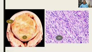 GAME 13  Leiomyoma  DrGShivashekar  Practical Pathology [upl. by Ailat316]