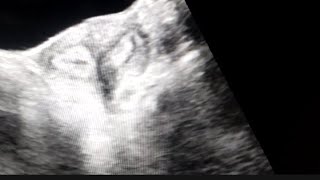 Bicornuate uterus on Ultrasound [upl. by Ketchum497]