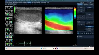 IQ 298 TESTIS HYPOECHIC STRAIN RATIO ELASTOGRAPHY ULTRASOUND HWD ECHOPAC ANALYSIS [upl. by Caresse234]