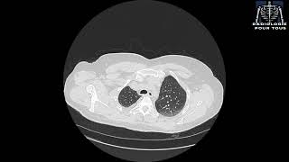 SCANNER THORACIQUE  Pleurésie bilatérale déjà traité pour TBK pulmonaire [upl. by Ynoyrb196]