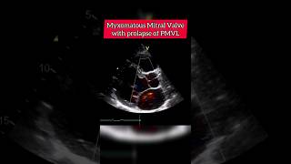 Myxomatous Mitral Valve with Prolapse of PMVL echocardiography heart [upl. by Auqinom]