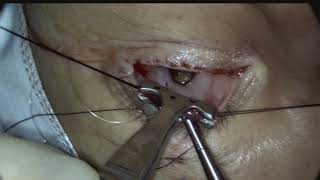 Posterior approach ConjunctivalMullers resection ptosis surgery Putterman procedure [upl. by Doscher217]