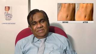 PRP මගින් සමේ Stretch Marks සදහා ප්‍රතිකාර [upl. by Tenney]