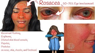 Rosacea  Red Bumpy Face Skin Rosacea Symptoms and treatment [upl. by Yelrehs]