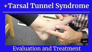 Positive Tarsal Tunnel SyndromeEval and Treatment [upl. by Ammeg]