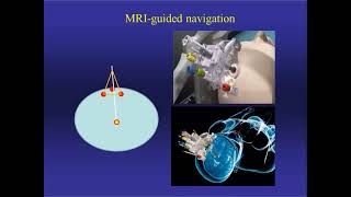 Neurosurgery On the Go Stereotaxis in NeuroOncology [upl. by Saidnac]