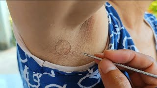 out ingrow armpit hair for ms uuimnnnddhhgg asmr [upl. by Scrivings]