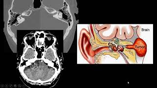 Schwannoma do acústico [upl. by Lemej804]