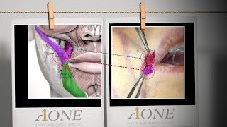 How to perform Smile Lipt Mouth corner lifting procedure and its effectiveness [upl. by Notsirb839]