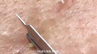 Popping Tons Of Blackheads Part 04 [upl. by Nilats]