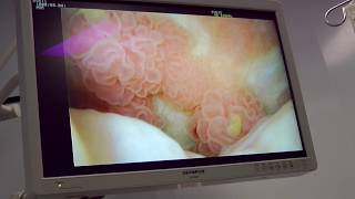 Cystoscopy 3 but still producing tumors Aug 2016 [upl. by Dorcea336]