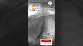 Barium swallow normal oesophagus constriction radiology xray mbbsstudent shorts [upl. by Curt181]