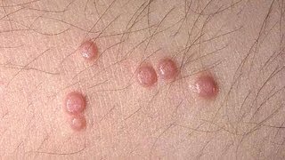 DermTV  Molluscum Contagiosum DermTVcom Epi 445 [upl. by Eveneg]