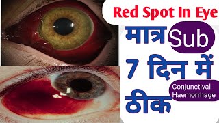 आंख में खून का थक्का जम जाना red spot in eyeshaemorrhge [upl. by Yrome256]