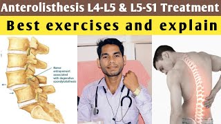 anterolisthesis l5 s1 treatment anterolisthesis grade 1 treatment exercises l4 l5 lumbar spine [upl. by Ydorb]