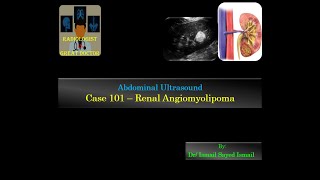 Ultrasound Case 101  Renal Angiomyolipoma [upl. by Block]