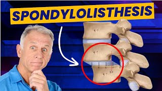 Spondylolisthesis 4 Exercises to Reduce Pain Demo on Real Patient [upl. by Thurstan]