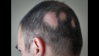 Alopecia areata Treatment  Intralesional Corticosteroid InjectionBy Dr sunny Rajput [upl. by Enahc]