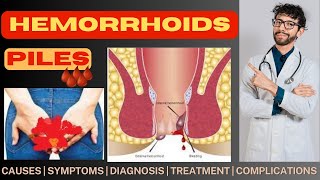 Hemorrhoids  Piles  Bawasir  Bawaseer  Causes  Symptoms  Stages  Treatment  Complication [upl. by Pharaoh]