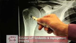 Rotator Cuff Impingement amp Tendonitis Part 2 Symptoms amp Evaluation [upl. by Melba]