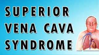 Superior Vena Cava Syndrome [upl. by Aid695]