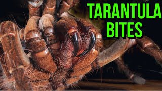 TARANTULA BITE First Aid Symptoms amp Prevention [upl. by Penney]