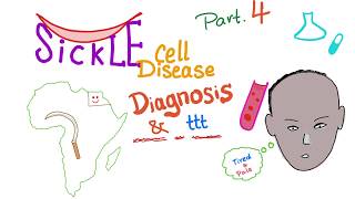 Sickle Cell Disease “part 4” Diagnosisamp treatment [upl. by Tandi]