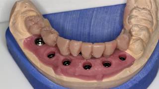 Pose de 6 implants dentaires en chirurgie mini invasive guidée [upl. by Macpherson]