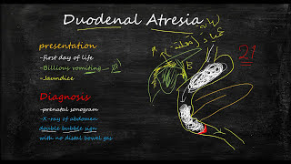 Duodenal atresia محاضرة في الاطفال وشرح للتشخيص والعلاج [upl. by Navinod211]