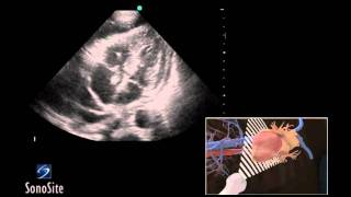 How To Ultrasound Guided Pericardiocentesis Procedure 3D Video [upl. by Reisfield]