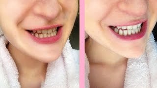 Crest white strips honest review [upl. by Ziagos]