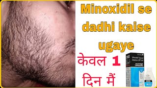 minoxidil se dadhi kaise ugaye  fast beard growth for minoxidil  The Suryavanshj [upl. by Brooking591]