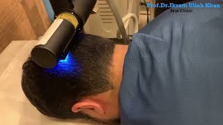 Suffer From Scalp Psoriasis You NEED to See This Laser Treatment lasertreatment psoriasis [upl. by Girard]