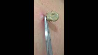 Tick removal by US doctor [upl. by Girard]