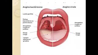 Les angine aigues Pr kharoubi meilleure explication 🤩🤩  ORL  ECN [upl. by Ennayelsel717]