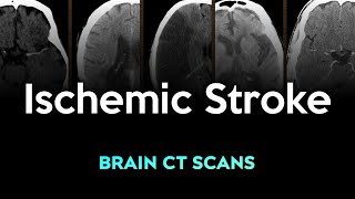 Ischemic Stroke Brain CT Scans [upl. by Neerol651]