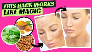 6 Easy Ways to Permanently Eliminate Hyperpigmentation [upl. by Savick]