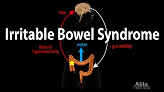 Irritable Bowel Syndrome Pathophysiology Symptoms Causes Diagnosis and Treatment Animation [upl. by Naibaf361]