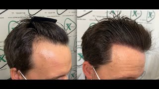 Trasplante Capilar  Hair Transplant  Dra Ximena Vila 3553 Grafts [upl. by Coh]